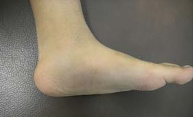 flat_feet
